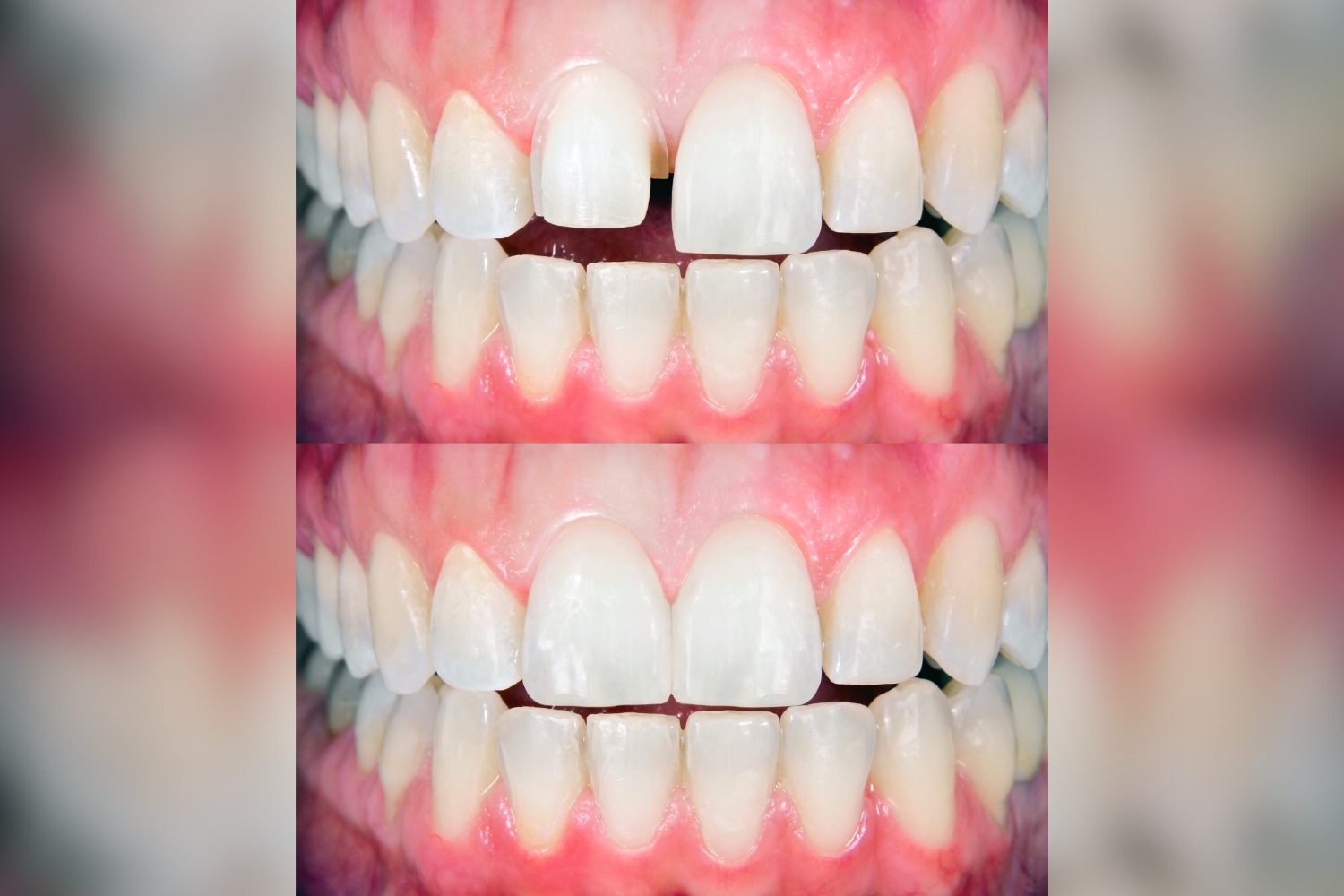 fixed teeth treatment Delhi