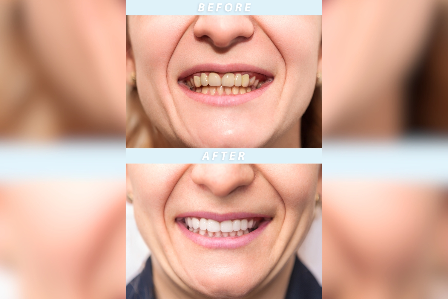 dental veneers treatment Delhi