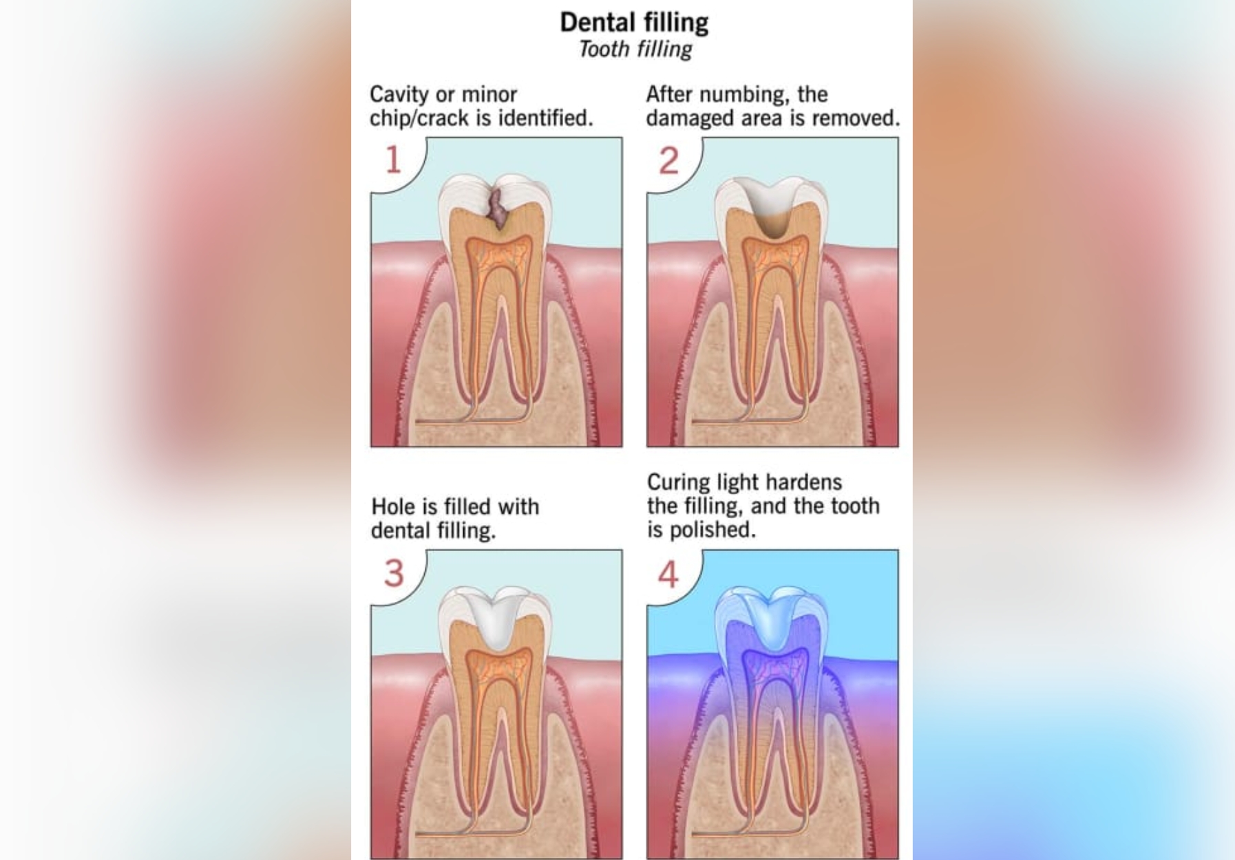 dental fillings treatment Delhi