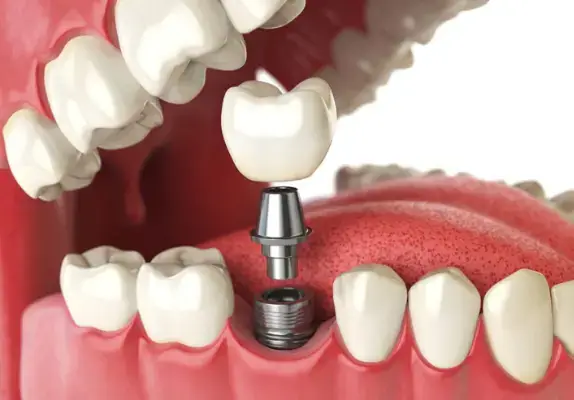 dental implants in Delhi