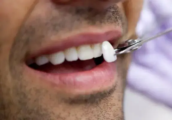 dental veneers treatment Delhi